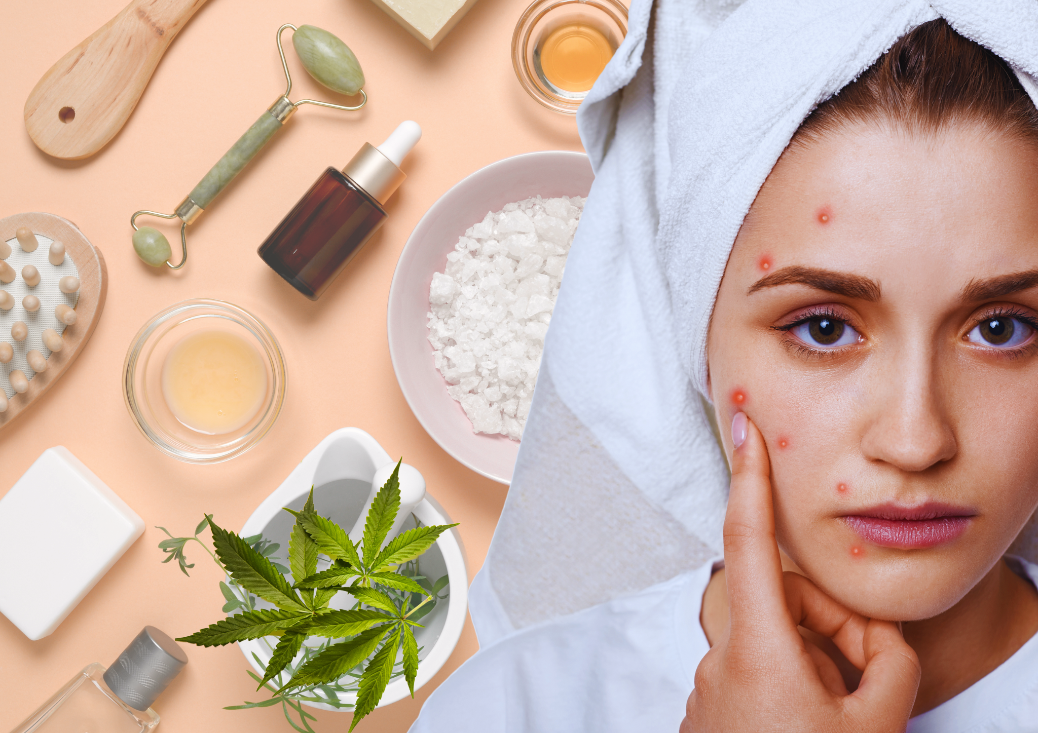 Cannabis: The Next Breakthrough for Acne Treatment?